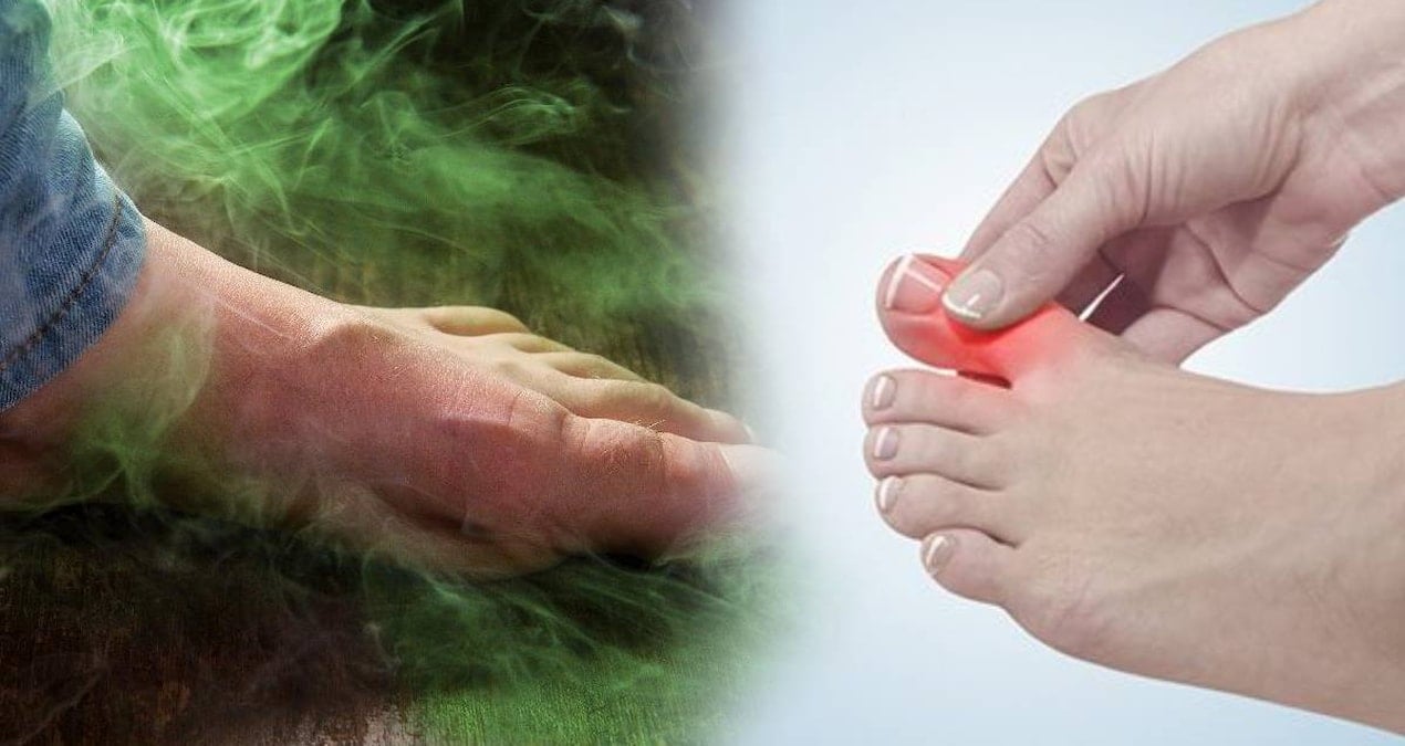 ayak mantarinin kokunu kurutuyor 2 malzeme yetiyor kokudan eser kalmiyor 81mzw4TA