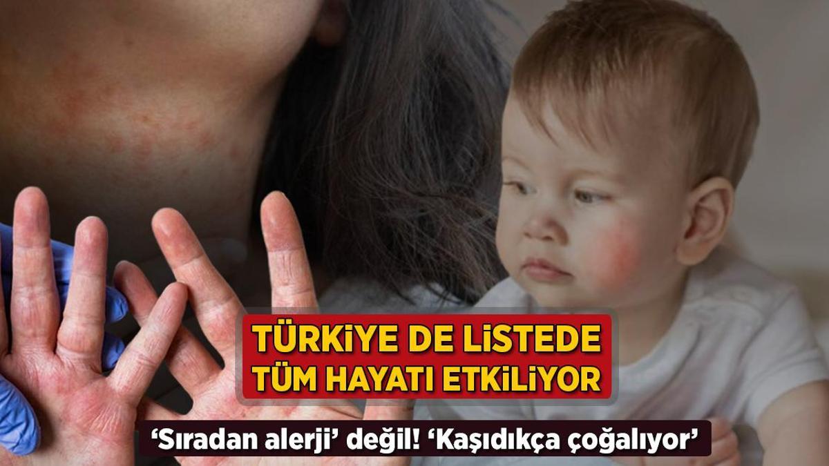 turkiye de listede tum hayati kotu etkiliyor siradan alerji degil kasidikca cogalir iehdjfbP.jpg